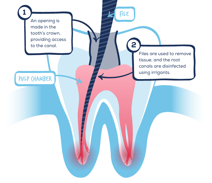 What to Expect from Root Canal Treatment GentleWave® Procedure